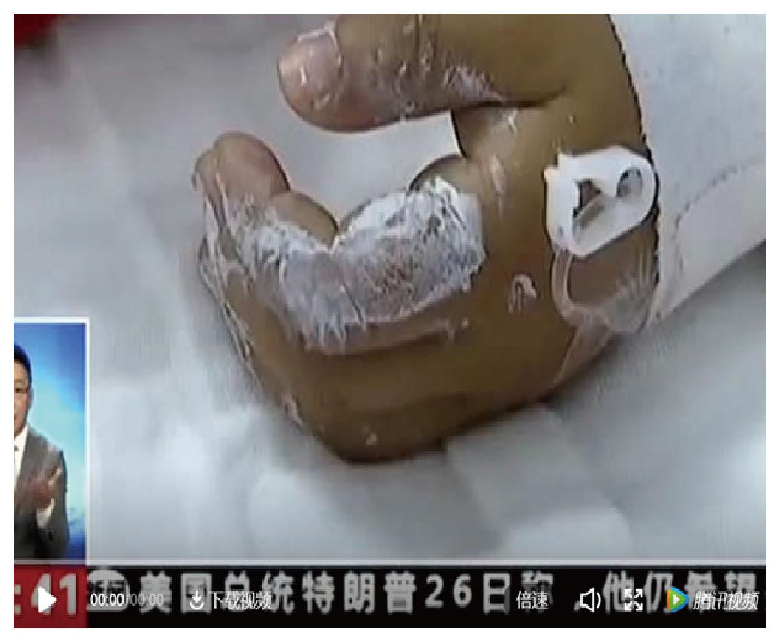 常见文具竟导致6岁男孩烧伤-01.jpg 常见文具竟导致6岁男孩烧伤-01.jpg