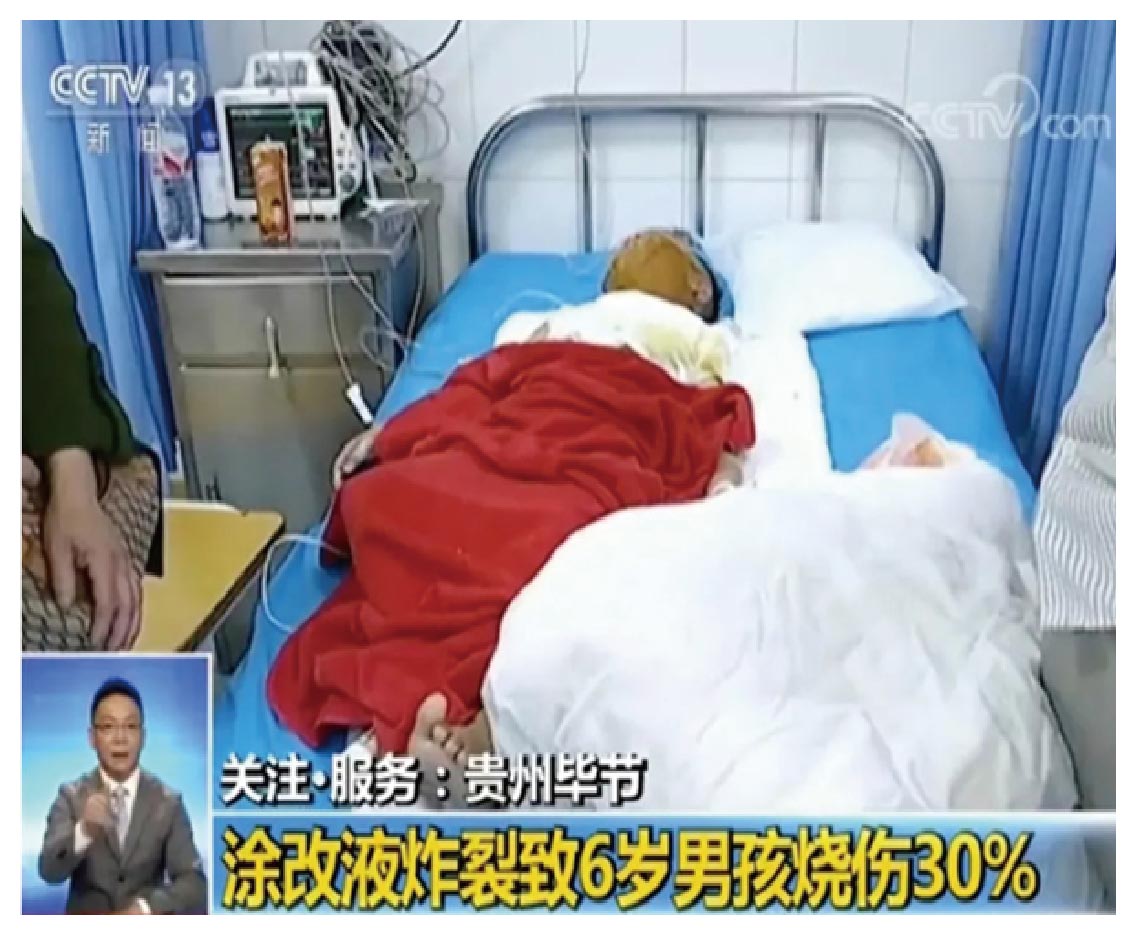 常见文具竟导致6岁男孩烧伤-02.jpg 常见文具竟导致6岁男孩烧伤-02.jpg